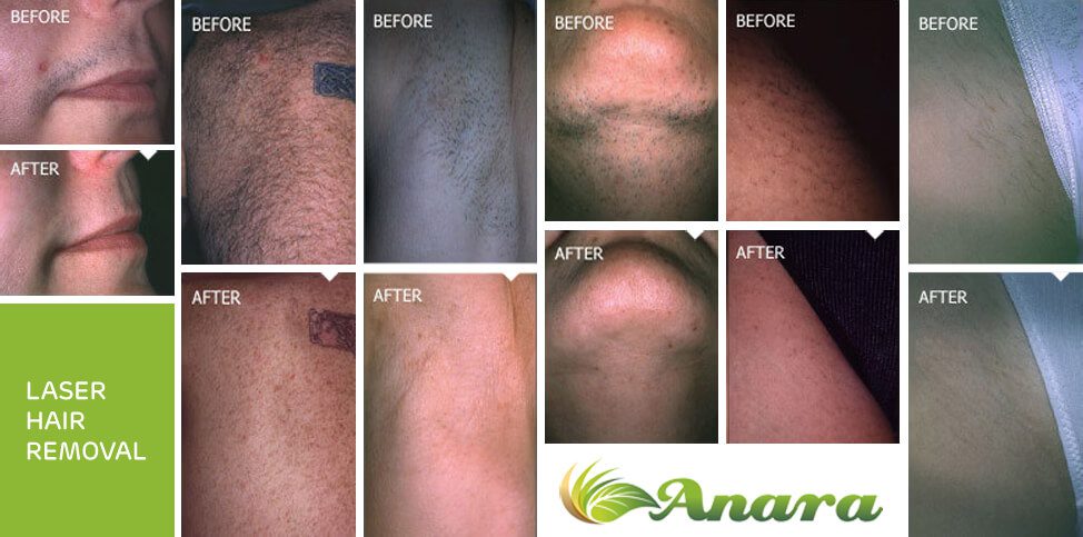 Permanent Laser Hair Reduction in New Jersey Permanent Laser Hair Reduction in New Jersey