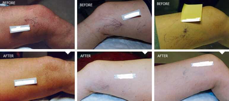 Laser Vein Removal in East Brunswick, NJ Laser Vein Removal in East Brunswick, NJ | Anara Medspa