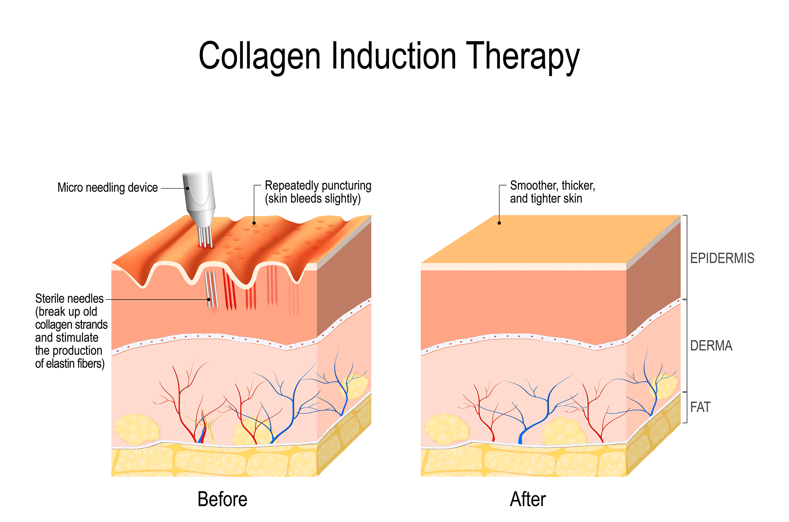 CIT Microneedling