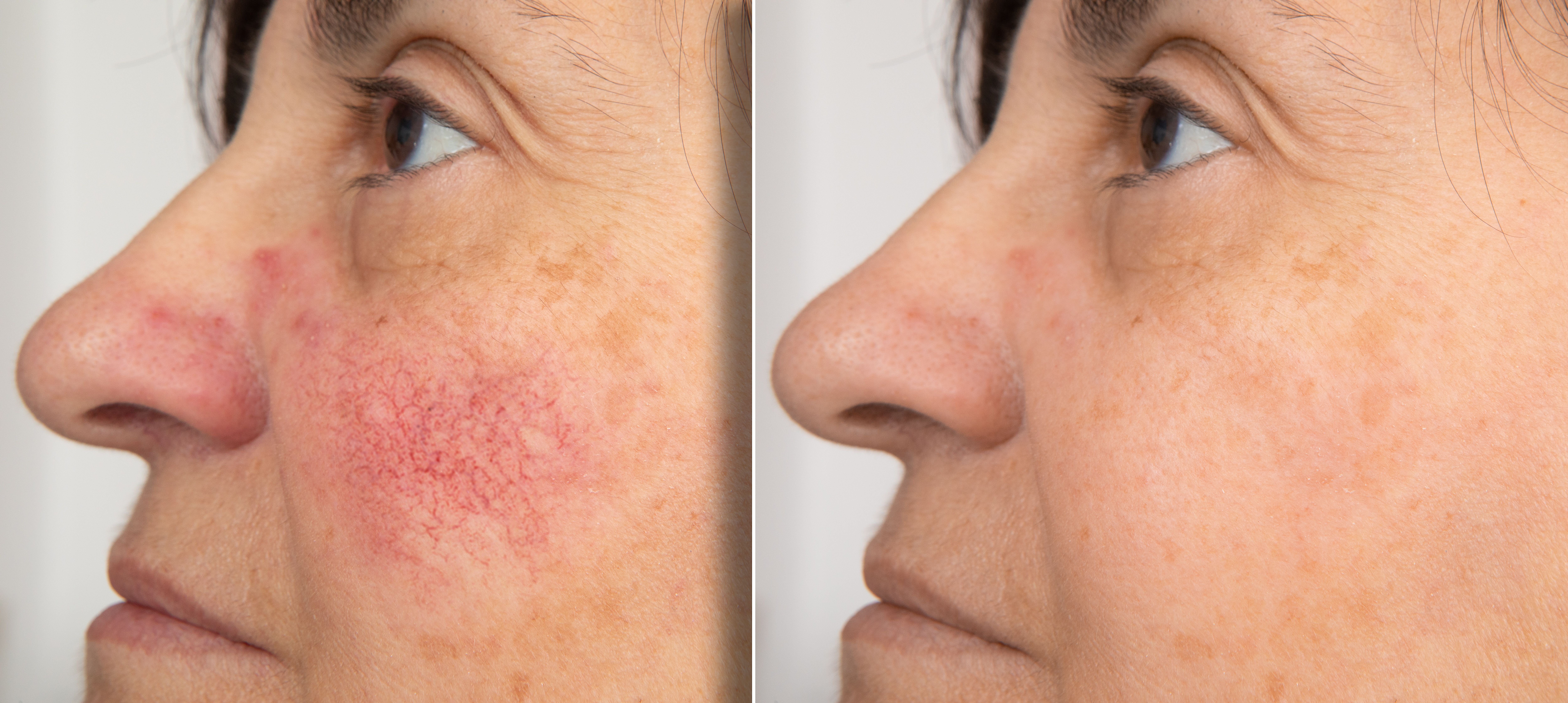 IPL Photofacial