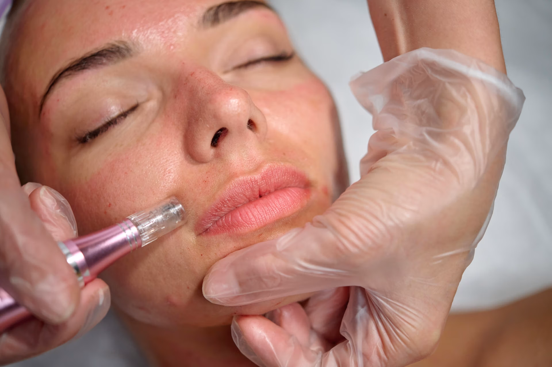 Microneedling Specialist for Professional Skin Treatments Microneedling Specialist for Professional Skin Treatments