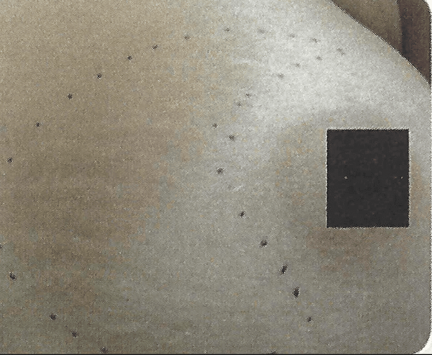 Stretch marks in a woman's breast before Palomar 1540 or Fraxel laser treatments