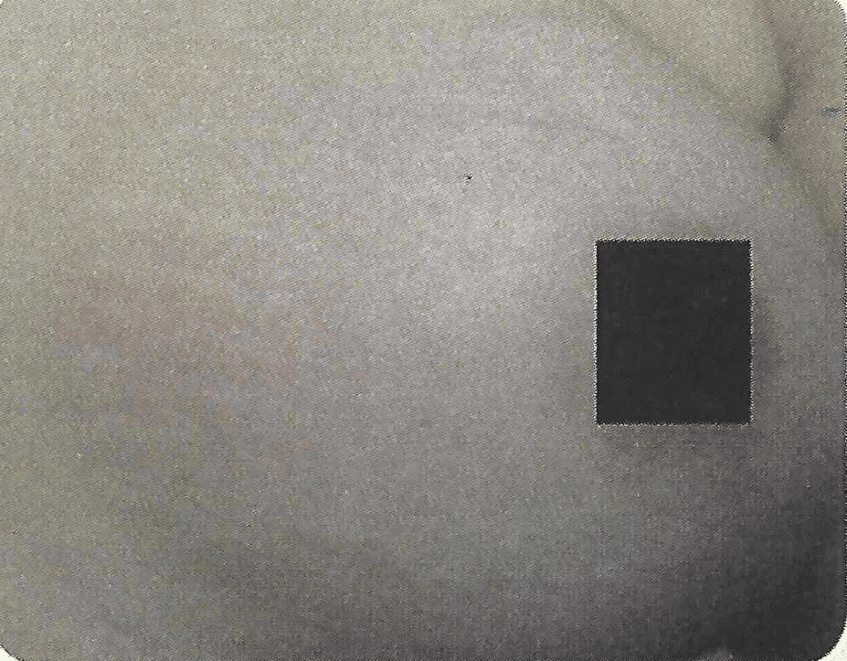 Improvement in stretch marks in a woman's breast after a series of Palomar 1540 or Fraxel laser treatments