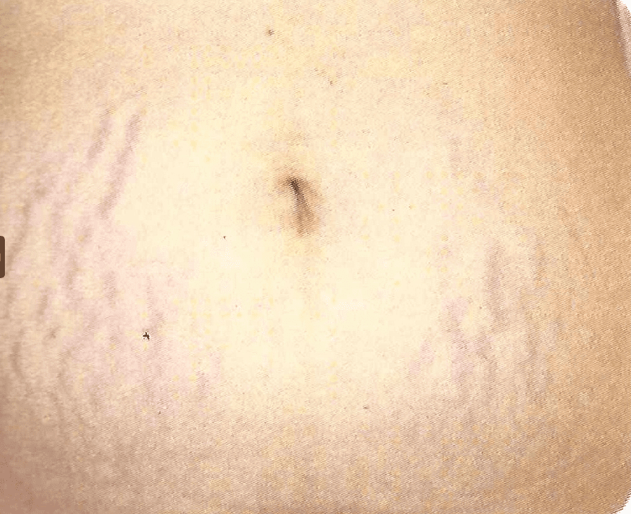 Pregnancy related reddish stretch marks in abdomen before Palomar 1540 or Fraxel laser treatments in East Brunswick NJ
