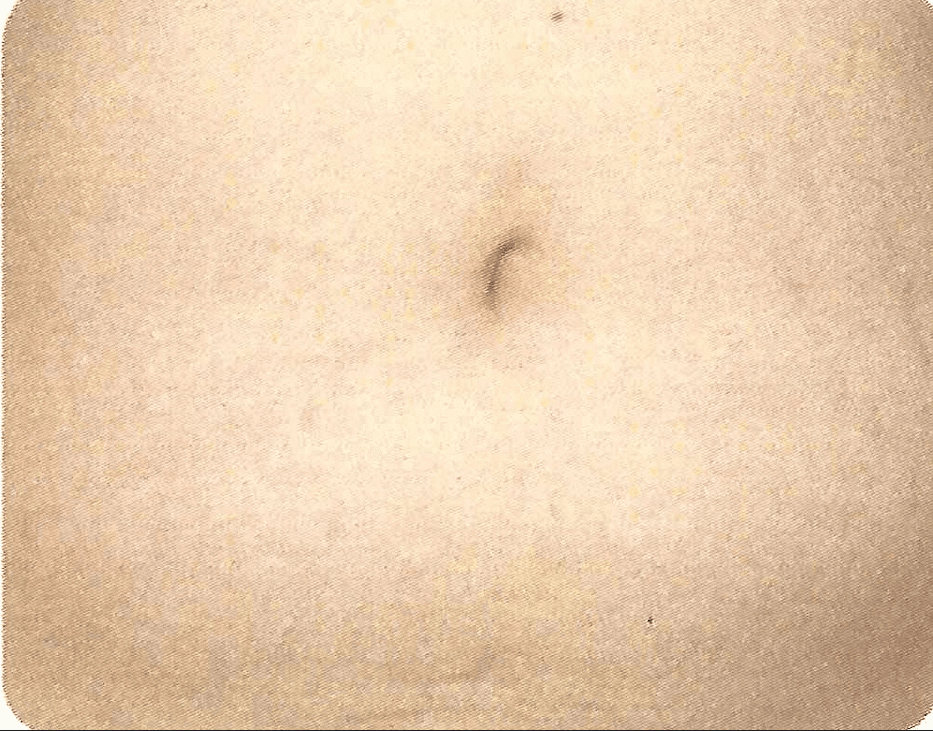 Improvement in pigmented stretch marks related to pregnancy after a series of Palomar 1540 or Fraxel lasers