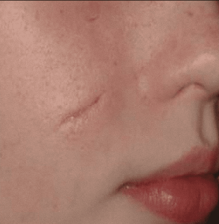 Linear scar on the right cheek before Fraxel or Palomar 1540 laser treatments