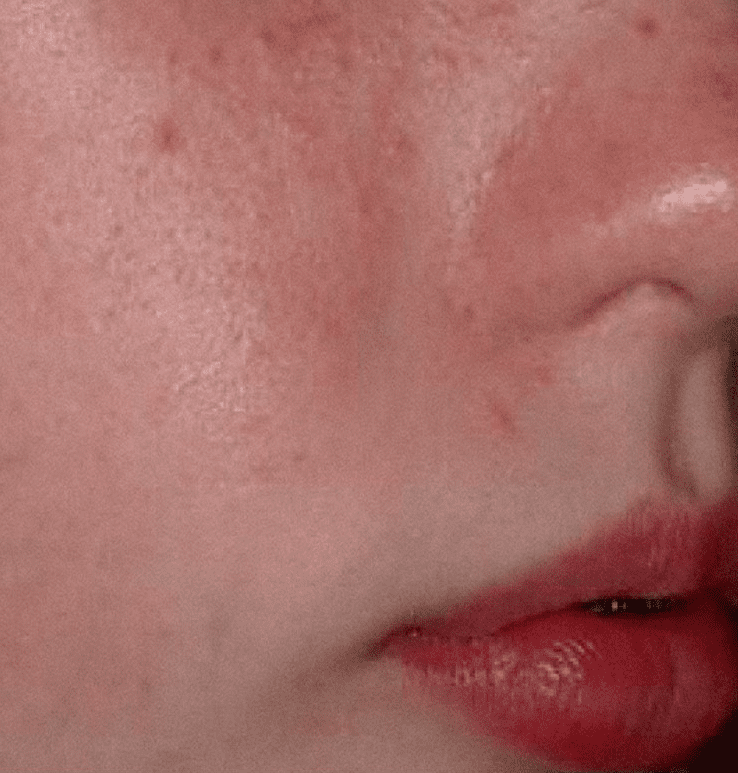 Improved scar in the right cheek after Fraxel or Palomar 1540 laser treatments in East Brunswick NJ