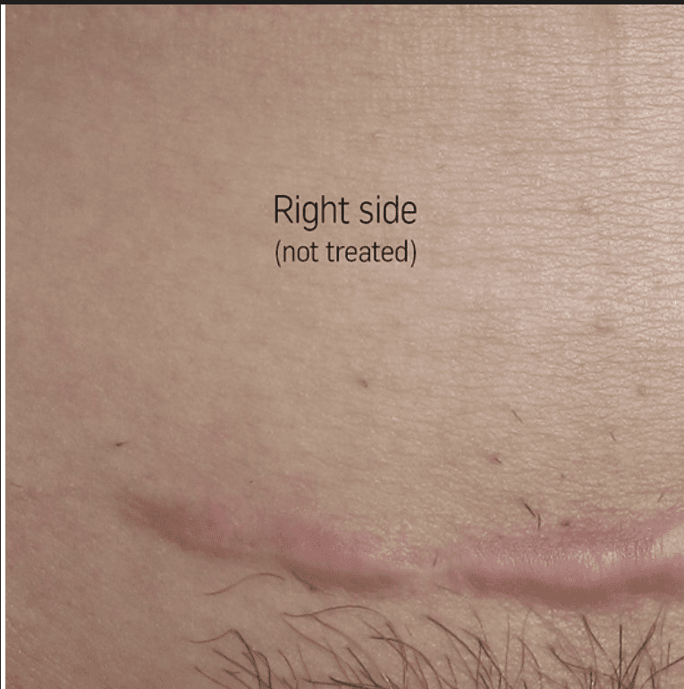C section scar in the abdomen before Palomar 1540 or Fraxel laser treatments