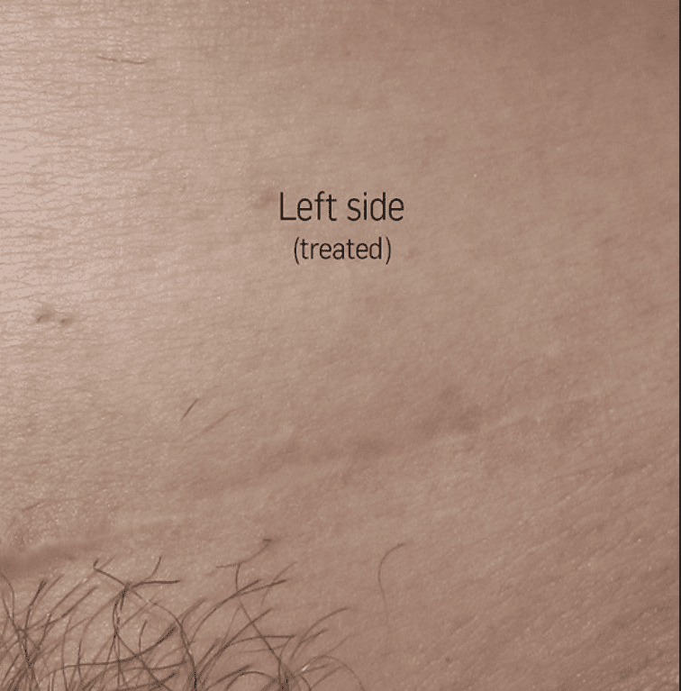 Improved C section scar in the abdomen after a series of Palomar 1540 or Fraxel laser treatments