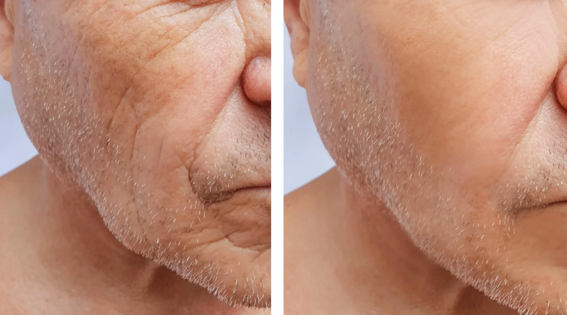 Sculptra treatment (Before-After) Sculptra treatment (Before-After)