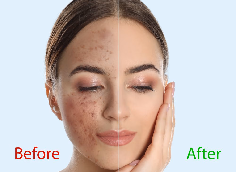 BioRePeel (Before-After) Acne treatment before and after in a woman's face