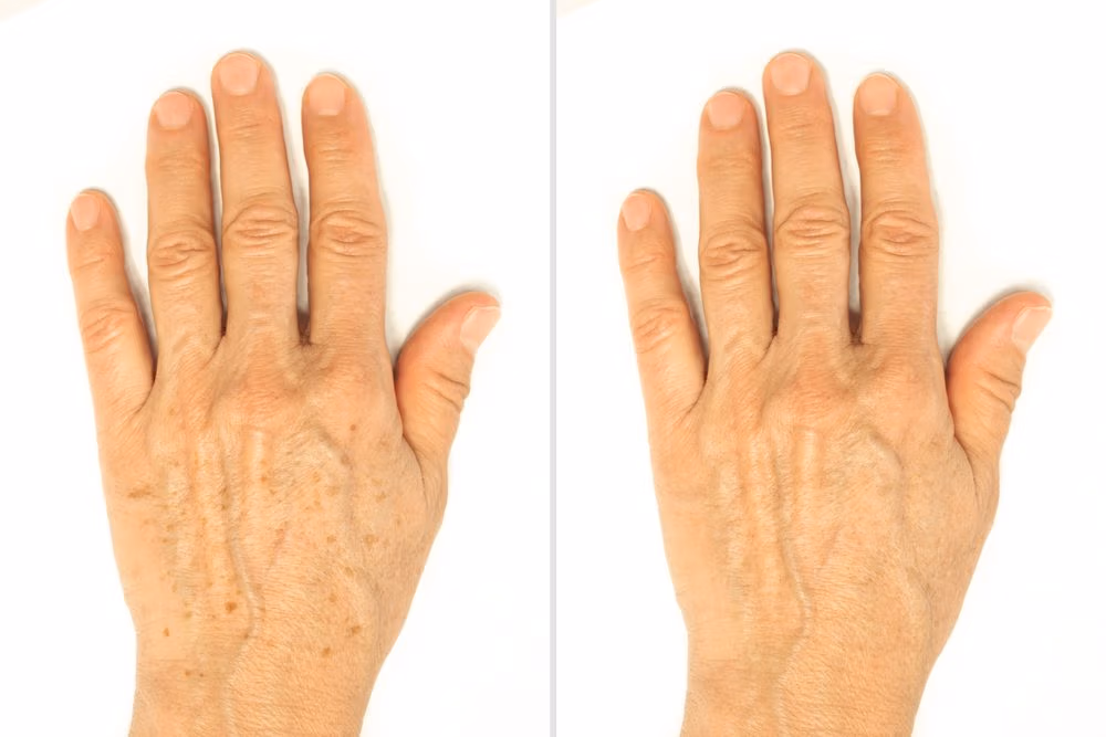 Hand rejuvenation treatment East Brunswick NJ