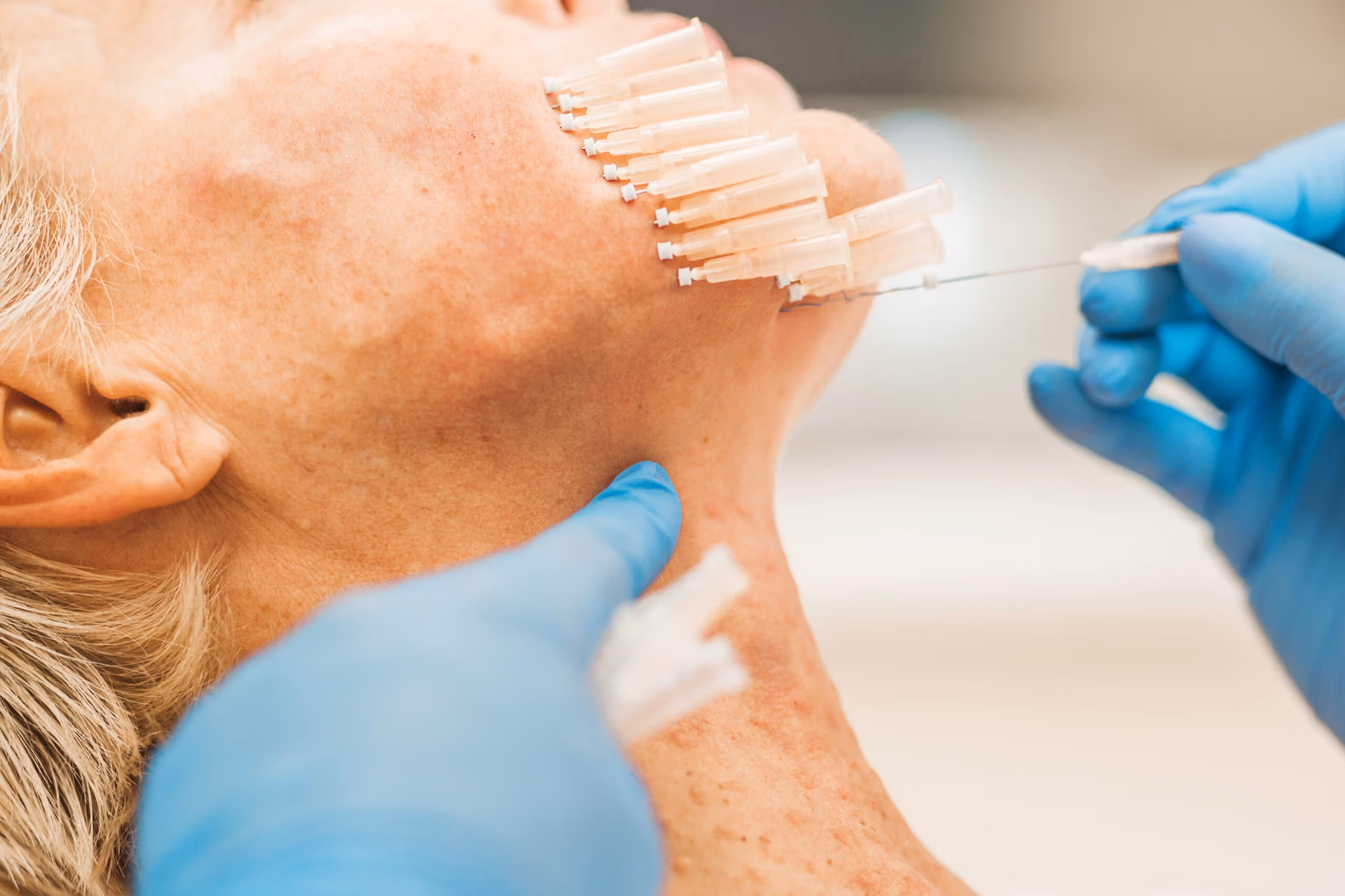 PDO smooth threads treatment in New jersey PDO smooth threads treatment in New jersey