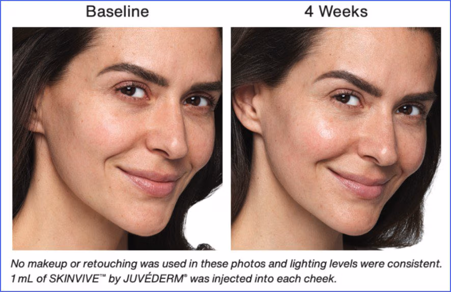 Juvederm Treatment in New jersey Juvederm SkinVive treatment results New Jersey
