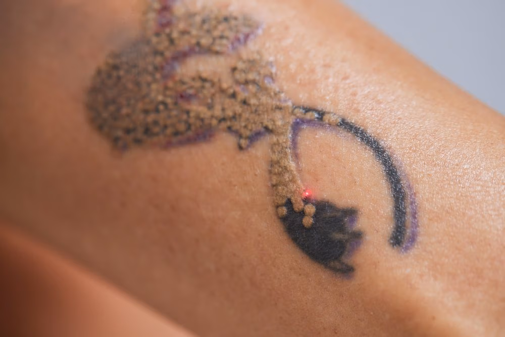 Laser Tattoo Removal at Anara Medspa Laser Tattoo Removal at Anara Medspa