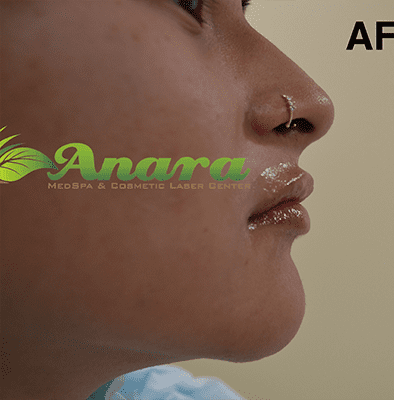 Side view of fuller pouty lips after lip filler in East Brunswick NJ