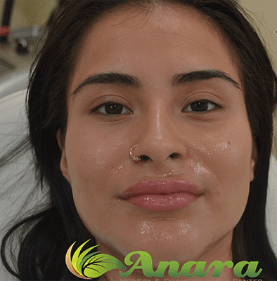 Front view of fuller lips after lip filler injection in East Brunswick NJ