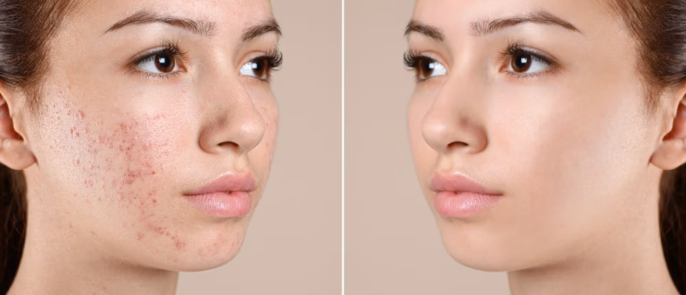 Acne treatment in new jersey